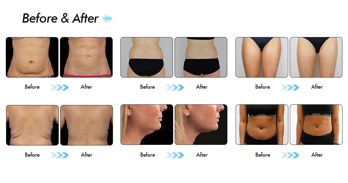 машина cryolipolysis жирная замерзая 5 машина Cryolipolysis аппликаторов 360 жирная замерзая для всего ухода за телом.