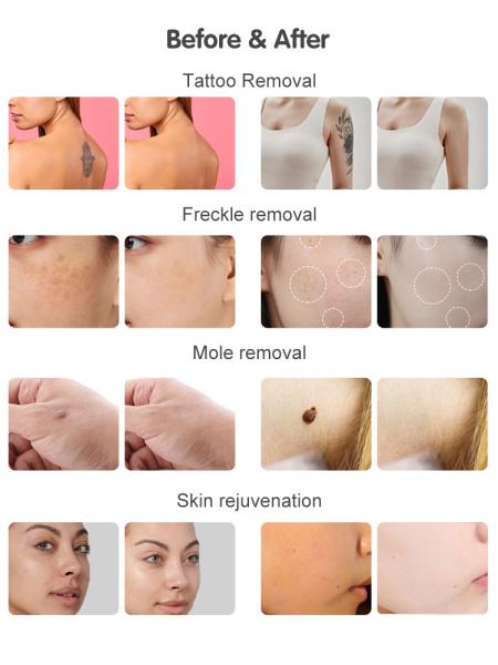 Picoseconde 532nm 755nm 1064nm Pigment machine à enlever les tatouages au laser pour la vente Pico