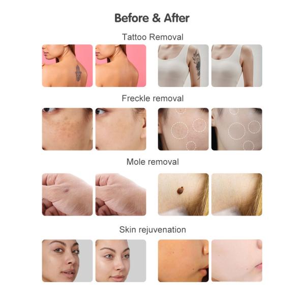 NIR Milk Light Whitening Ice 808nm Diode Laser Device 4 Wavelength 755 808 940 1064 Diode Laser Hair Removal Machine