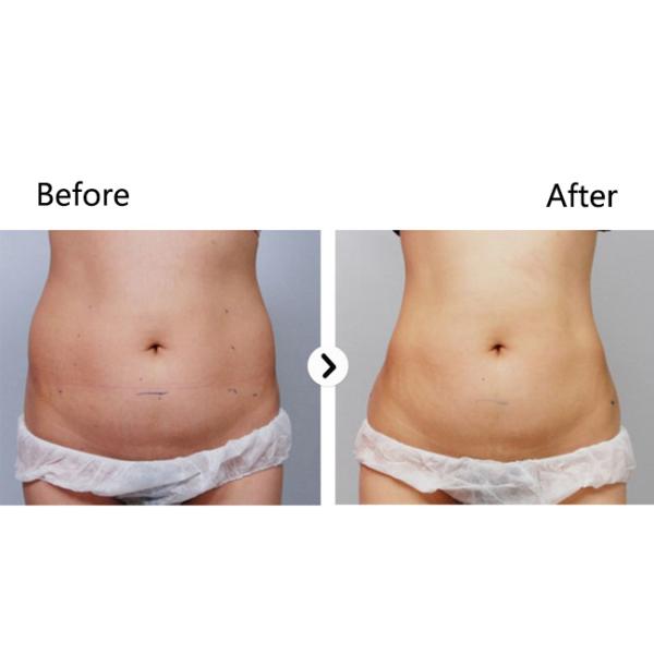 2 ручки снимают кожу со для того чтобы затянуть безболезненную машину ЛЬДА 5D Hifu