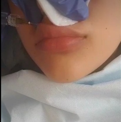 Заполнитель ХА вводимый дермальный лицевой, заполнитель впрыски Хялуроник кислоты с Лидокайне