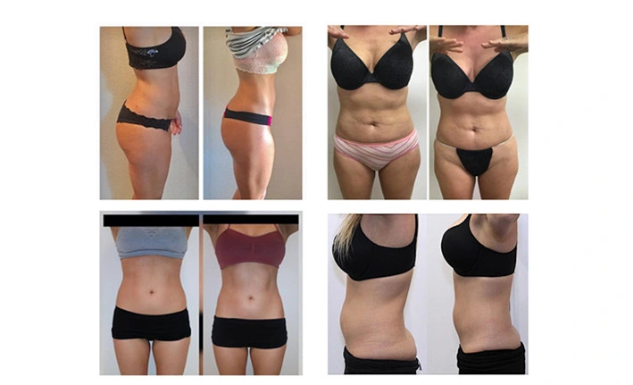 Advanced 6D lipolaser lipolysis 209mw Super 6d Lipo Laser Liposuction Machine with 635nm 650nm 780nm 810nm 940nm 980nm