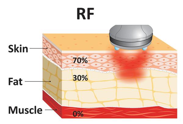 Esculptura corporal de ondas frias Radiofrequência Apertar a pele Quente Frio Cryo Beauty Slimming Machine
