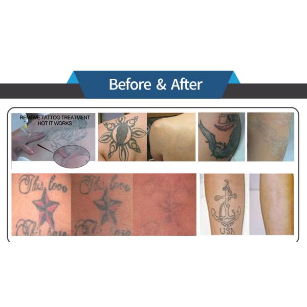 Tuv Approved Laser Tattoo Removal Equipment Q Switched Nd Yag For Beauty Salon