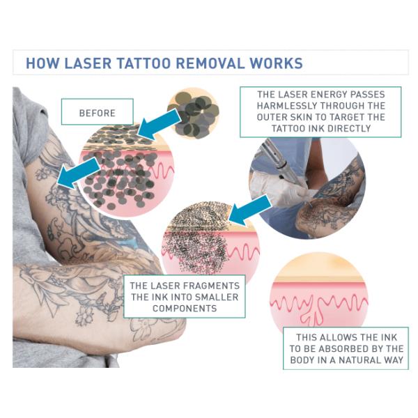 лазер yag nd переключателя 1064nm 532nm q пульсировал лазер для подмолаживания кожи удаления татуировки