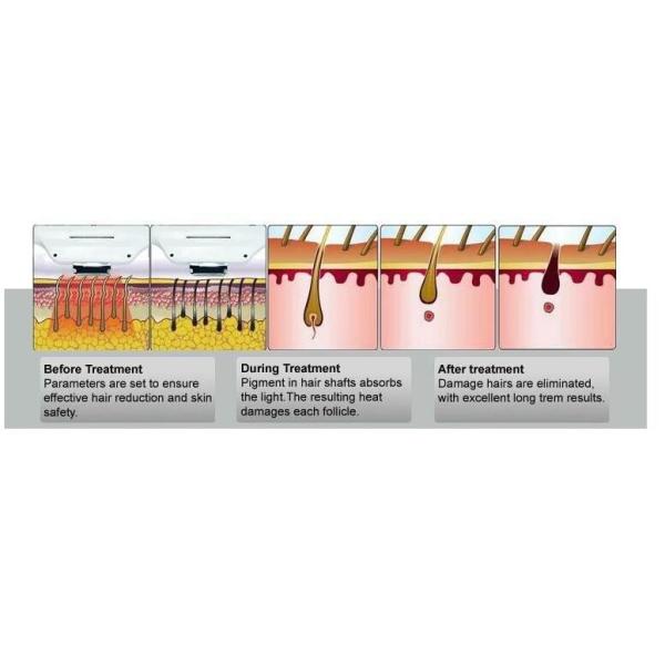 4 In 1 E - Light IPL Opt Yag Laser Tattoo Removal Machine , SHR Laser Hair Removal Device