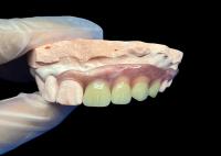 Dentaduras parciales invisibles flexibles para un ajuste cómodo y seguro y una estética natural