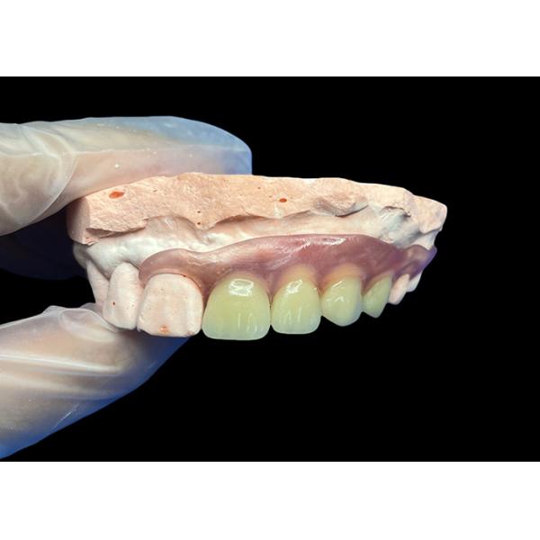 Réglabilité et stabilité Prothèses dentaires amovibles