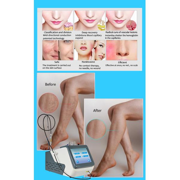 980 нм лазерная липосакционная машина для похудения