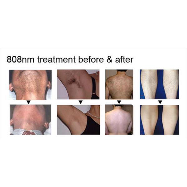 Portable Diode Laser Hair Removal 808 Freezing Point Adjustable Energy