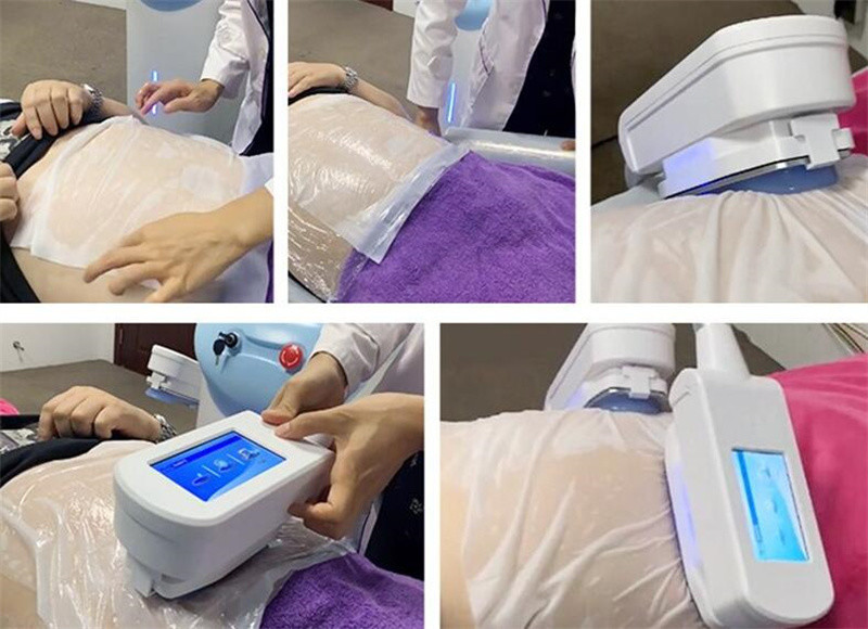 10,4» углов 360 окружая замораживание Cryolipolysis жирное уменьшая машину для жирного удаления