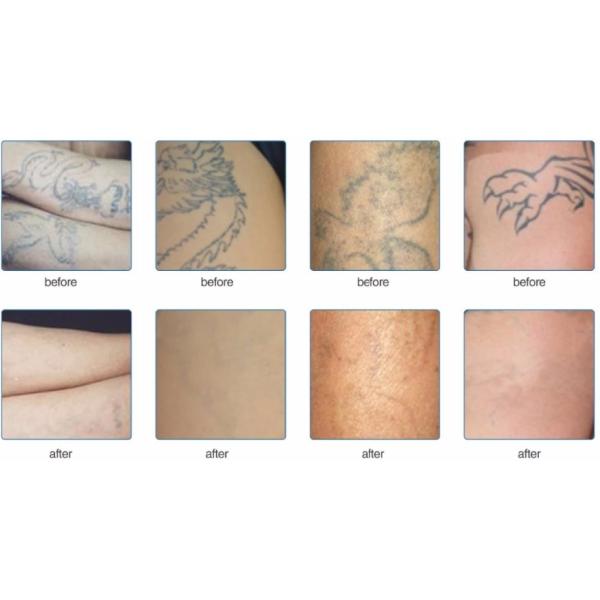 Оборудование удаления татуировки лазера пикосекунды/коммерчески прибор удаления татуировки