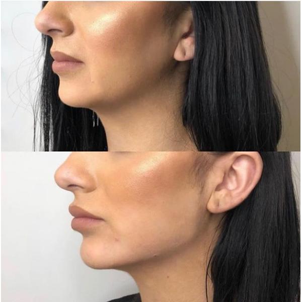 Морщинок заполнителя Juvederm Ultra4 24mg/Ml впрыска дермальных анти- Hyaluronic кисловочная