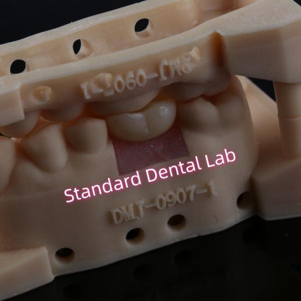 Coroa de implante de abutment personalizado de contorno completo de tornillo de zirconia retenido
