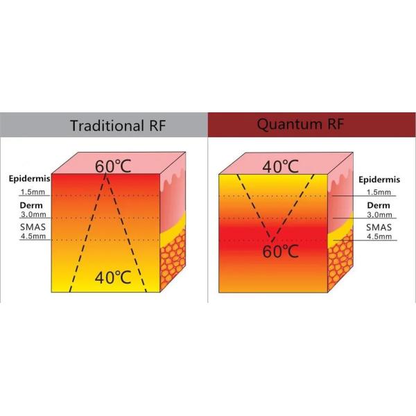 Machine de levage du visage non chirurgicale 120VA noire