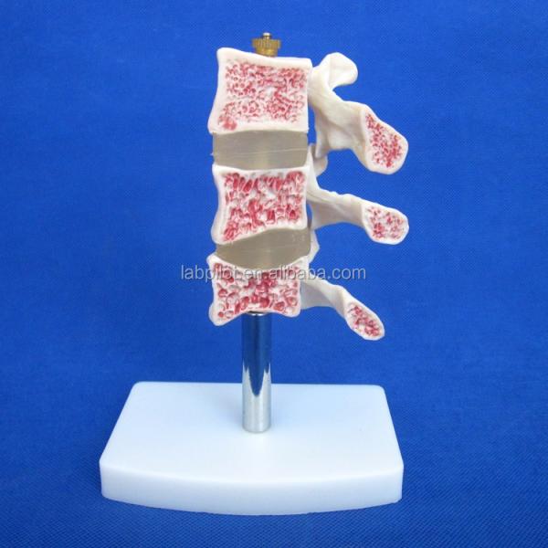 Advanced PVC Educational Models Cutaway Osteoporosis of Spine Lesions of Lumbar Vertebra
