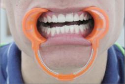Disposable Cheek Retractors Dental Medical Dental  Cheek Retractor Soft Dental  Retractor