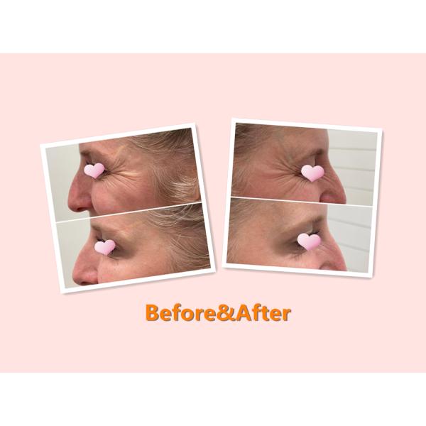 100Units Allergan Botulinum Toxion для извлекают лицевой тип a Botox морщинок