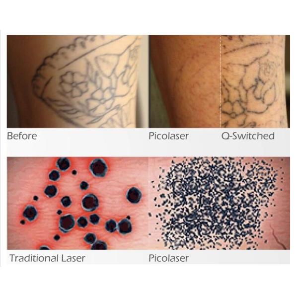 Picosecond Laser Tattoo Removal Machine , Skin Rejuvenation Nd Yag Laser Machine