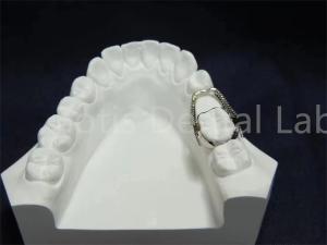 Adjustable Retainer Expander Convenient Orthodontic Solution Easy Maintenance