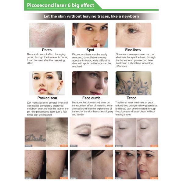 OEM машины удаления татуировки лазера Nd Yag Picosure пикосекунды для салона