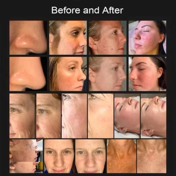 Cold Plasma Acne Spot Scar Wrinkle Removal Jet Plasma Beam Skin Rejuvenation