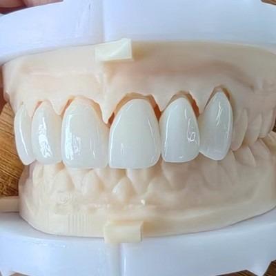 Esthétique naturelle pont de couronne en zirconium en couches pour un beau sourire et une bonne restauration