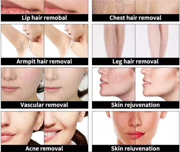 Commercial Multifunctional Beauty Machine 755nm 808nm 1064nm For IPL Opt Laser Hair Removal