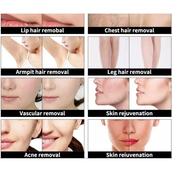 Épilation laser à diode portative 808nm Picosecond Machine d'épilation de tatouage