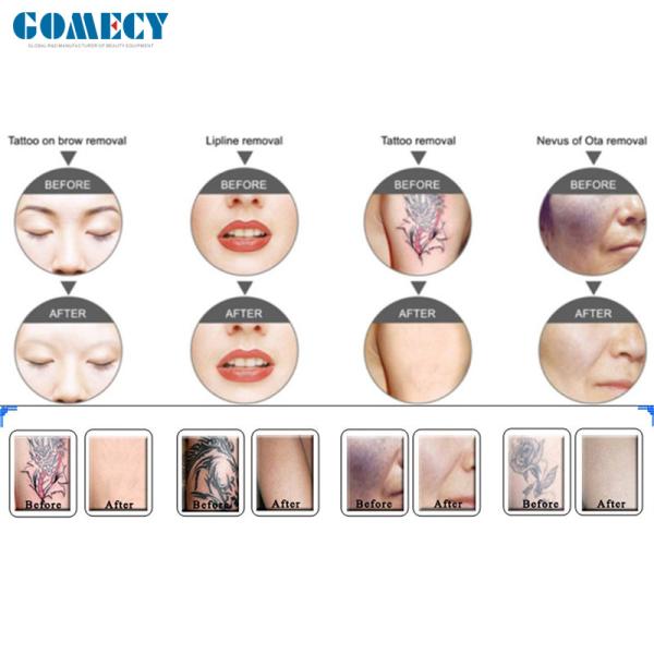 Popular Nd Yag Tattoo Removal Laser Machine For Skin Whitening