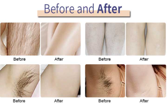 Permanent 810nm Diode Laser Hair Removal Machine