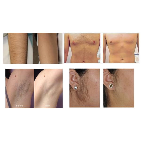 Fast 810nm Diode Laser Hair Removal Machine , Big Spot Size Lightsheer Diode Laser