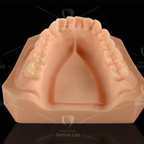 High Strength Zirconia Inlay Onlay Zirconia Restorations CAD / CAM Digital Milling