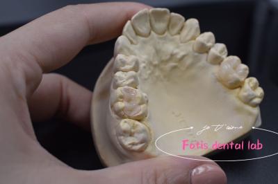 Effective E.Max / Composite Inlays And Onlays For Repair Damaged Or Decayed Teeth