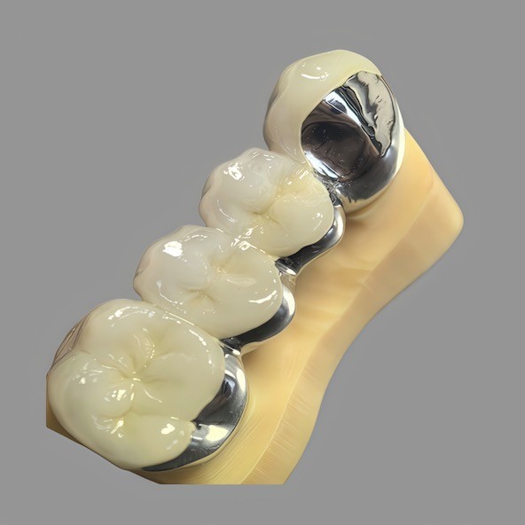 Casting / Digital CoCr Dental PFM Bridge with Polished Surface