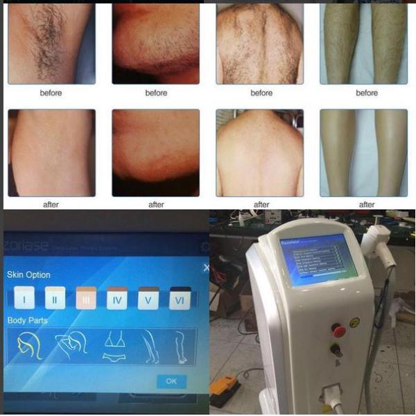 Stationary Diode Laser Hair Removal Machine