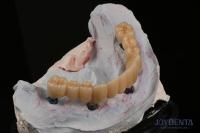 Dental Restorations Multiple Teeth Implant Endosseous Replace Two Front Teeth