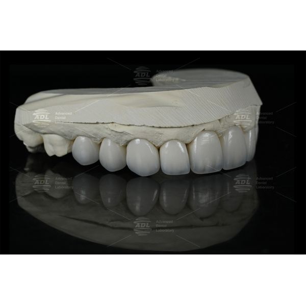 0.3mm-0.7mm Feldspathic EMAX Ceramic Veneers Natural Aesthetic Emax Dental Veneers