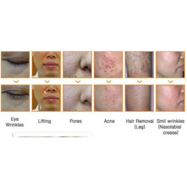 China professional best home portable ellipse ipl intense pulse shr facial body hair removal machine with cheap cost