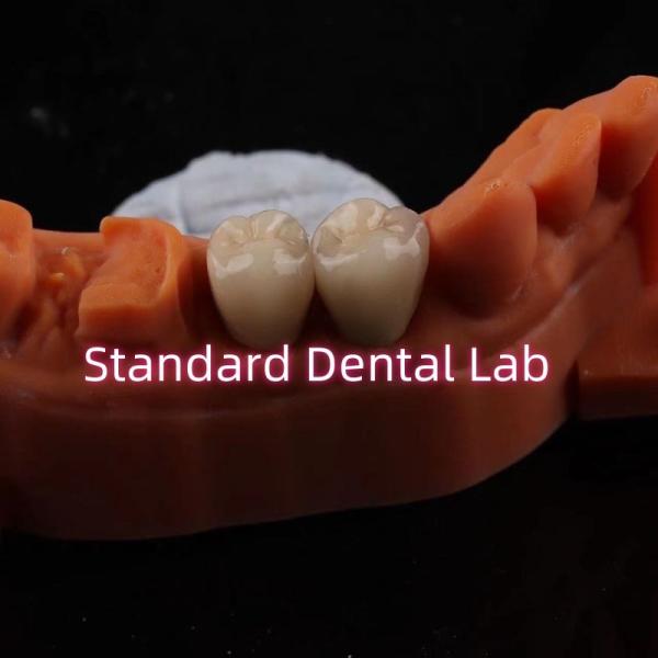 Металлическая корневая корона CAD CAM Порцелан / циркония