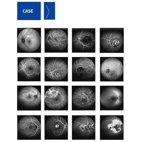 Confocal Retina Ophthalmoscope One Integrated Lens Camera System Multi Imaging Modes