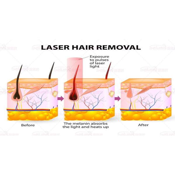 Micro Channel 808nm Diode Hair Removal Laser Machine With Germany Laser Bar