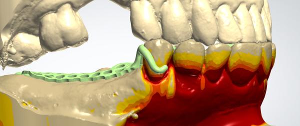 Digital Metal Framework CAD CAM Dental Design Cocr Material With 3D Printing