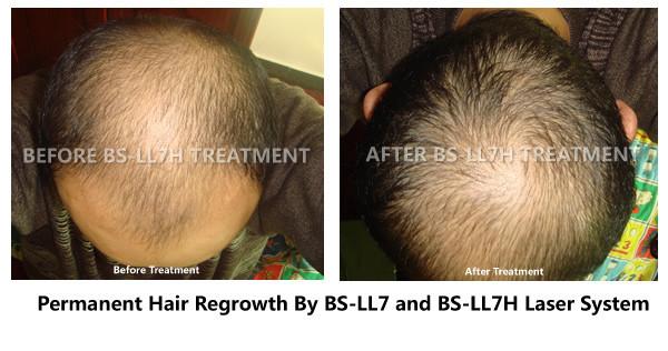 300 Watts Clinic Laser Treatment For Hair Loss , Low Level Laser Therapy Hair Loss Painless