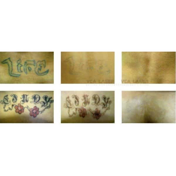 OEM Design portable Laser Tattoo Removal pigment birthmark removal