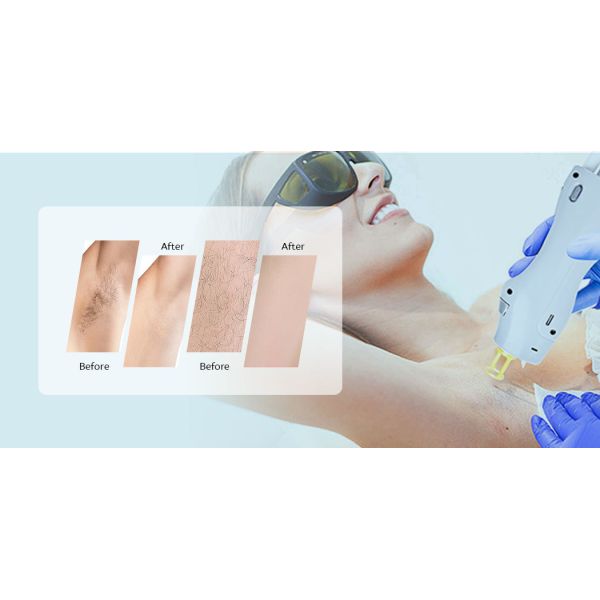 Premium Long Pulse Alexandrite Laser System Gold Standard For Hair Removal Skin Rejuvenation