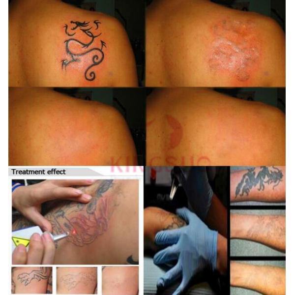 1064nm 532nm q switch nd yag laser medical system/medical laser tattoo removal system