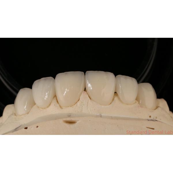 Precise Zirconia Crown Bridge Comfortable Fit / Esthetics 3-4 Days Quick Turnaround Time