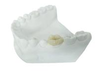 Onlay dental Todo-cerâmico durável do embutimento do folheado da coroa de FDA similar