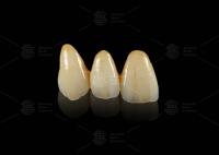 Ponte Dental EMAX Hipoalergênico Durável